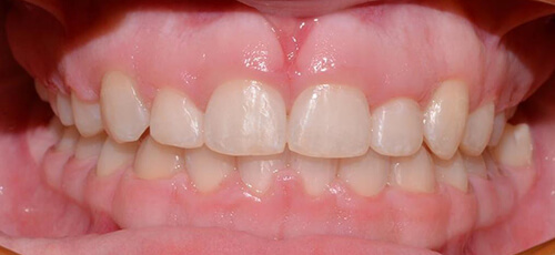 Deep Overbite, Narrow Arches and Crowding After